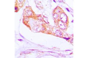 Immunohistochemical analysis of PNPT1 staining in human lung cancer formalin fixed paraffin embedded tissue section.