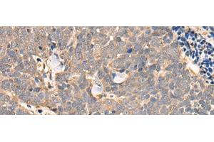 Immunohistochemistry of paraffin-embedded Human thyroid cancer tissue using NCAPH Polyclonal Antibody at dilution of 1:45(x200) (NCAPH antibody)