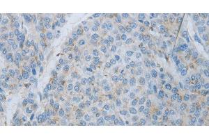 Immunohistochemistry of paraffin-embedded Human liver cancer using MMP25 Polyclonal Antibody at dilution of 1:80 (MMP25 antibody)