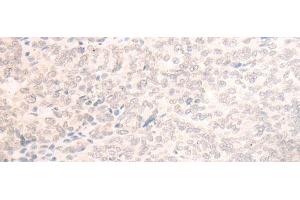 Immunohistochemistry of paraffin-embedded Human ovarian cancer tissue using EME2 Polyclonal Antibody at dilution of 1:40(x200)