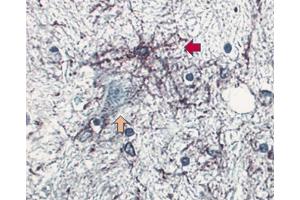 Formalin-fixed, paraffin embedded section of human brain stained for GFAP (clone 4A11, ABIN967499) using a DAB chromogen and hematoxylin counterstain. (GFAP antibody)