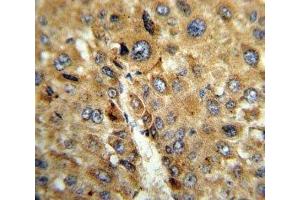 IHC analysis of FFPE human hepatocarcinoma stained with TAT antibody (Tat (AA 279-306) antibody)