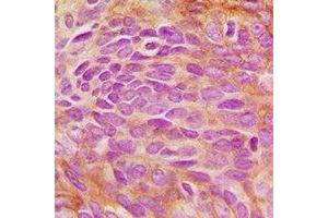 Immunohistochemical analysis of ERK5 staining in human breast cancer formalin fixed paraffin embedded tissue section. (MAPK7 antibody)