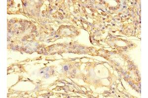 Immunohistochemistry of paraffin-embedded human pancreatic cancer using ABIN7166432 at dilution of 1:100 (METTL21C antibody  (AA 6-145))