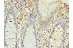 Immunohistochemistry of paraffin-embedded human colon cancer using ABIN7153785 at dilution of 1:100 (GTF3C6 antibody  (AA 2-213))