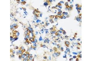 Immunohistochemistry of paraffin-embedded Human lung cancer using APOBEC3F Polyclonal Antibody at dilution of 1:100 (40x lens). (APOBEC3F antibody)