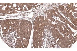 IHC-P Image Immunohistochemical analysis of paraffin-embedded Gastric CA N87 xenograft, using RPL5, antibody at 1:100 dilution. (RPL5 antibody)