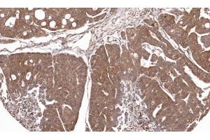 IHC-P Image Immunohistochemical analysis of paraffin-embedded Gastric CA N87 xenograft, using RPL5, antibody at 1:100 dilution.
