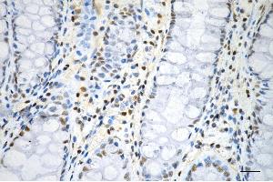 Immunohistochemistry was performed on paraffin-embedded human sigmoid colon carcinoma using phospho-histone H3 (S28) antibody (ABIN7798976), 1:200).