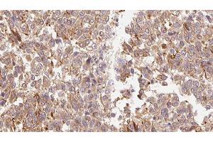 ABIN6278899 at 1/100 staining Human Melanoma tissue by IHC-P. (IL-3 antibody  (Internal Region))
