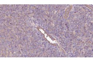 ABIN6273064 at 1/100 staining Human lymph cancer tissue by IHC-P.