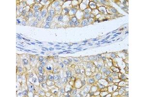 Immunohistochemistry of paraffin-embedded Human prostate cancer using BMP4 Polyclonal Antibody at dilution of 1:100 (40x lens). (BMP4 antibody)