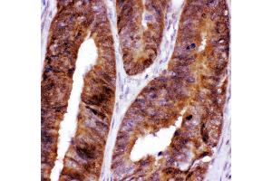 Anti- FOXO3A antibody,IHC(P) IHC(P): Human Intestinal Cancer Tissue (FOXO3 antibody  (AA 471-673))