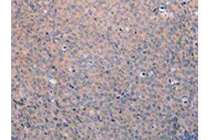 The image on the left is immunohistochemistry of paraffin-embedded Human cervical cancer tissue using ABIN7189808(ANKRD26 Antibody) at dilution 1/25, on the right is treated with synthetic peptide. (ANKRD26 antibody)
