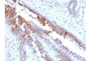 Formalin-fixed, paraffin-embedded human Breast Carcinoma stained with Mammaglobin Recombinant Rabbit Monoclonal Antibody (MGB1/2123R).