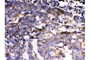Anti- MAPK6 Picoband antibody, IHC(P) IHC(P): Human Lung Cancer Tissue (MAPK6 antibody  (AA 520-721))