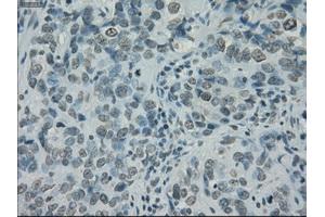 Immunohistochemical staining of paraffin-embedded Carcinoma of thyroid tissue using anti-PRKYmouse monoclonal antibody. (PRKY antibody)