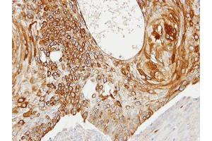 IHC-P Image Immunohistochemical analysis of paraffin-embedded HSC3 xenograft, using Creatine kinase (brain), antibody at 1:100 dilution. (CKB antibody)