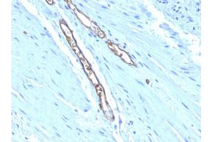 Formalin-fixed, paraffin-embedded human Colon Carcinoma stained with Blood Group Antigen A Monoclonal Antibody (HE-193) (ABO antibody)