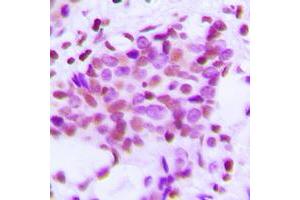 Immunohistochemical analysis of Hexokinase 1 staining in human breast cancer formalin fixed paraffin embedded tissue section. (Hexokinase 1 antibody  (N-Term))