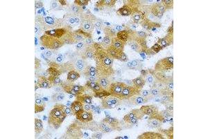 Immunohistochemical analysis of KLK10 staining in human liver cancer formalin fixed paraffin embedded tissue section. (Kallikrein 10 antibody)
