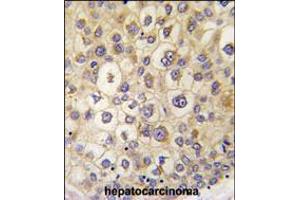 Formalin-fixed and paraffin-embedded human hepatocarcinoma tissue reacted with ARHE antibody , which was peroxidase-conjugated to the secondary antibody, followed by DAB staining. (RND3 antibody  (AA 133-165))