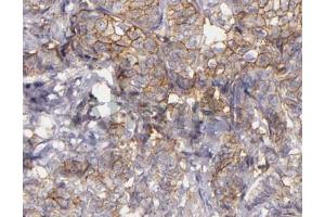 ABIN6268685 at 1/100 staining human lung carcinoma tissue sections by IHC-P. (CD9 antibody  (Internal Region))