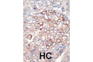 Formalin-fixed and paraffin-embedded human cancer tissue reacted with the primary antibody, which was peroxidase-conjugated to the secondary antibody, followed by DAB staining. (PIK3R4 antibody  (N-Term))