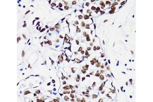 Immunohistochemistry of paraffin-embedded Human breast using Acetyl-Histone H4-K8 Polyclonal Antibody at dilution of 1:100 (40x lens). (Histone H4 antibody  (acLys8))