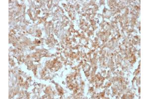 Formalin-fixed, paraffin-embedded human GIST stained with DOG-1 Mouse Recombinant Monoclonal Antibody (rDG1/447).
