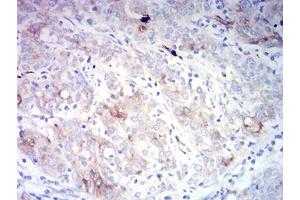 Immunohistochemical analysis of paraffin-embedded cervical cancer tissues using CD66A mouse mAb with DAB staining. (CEACAM1 antibody  (AA 65-201))
