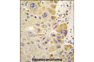 Formalin-fixed and paraffin-embedded human hepatocellular carcinoma reacted with ALDH2 polyclonal antibody  , which was peroxidase-conjugated to the secondary antibody, followed by DAB staining.