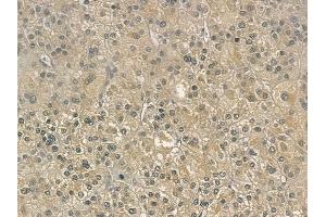 ABIN6257240 and ABIN6275170 at 1/100 staining human hepatocellular carcinoma by IHC-P.