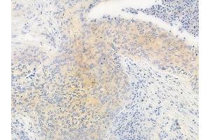 ABIN6263140 and ABIN6266983 at 1/100 staining human gastric carcinoma by IHC-P. (MAST4 antibody  (N-Term))