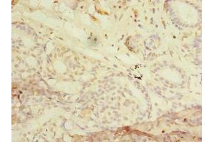 Immunohistochemistry of paraffin-embedded human breast cancer using ABIN7168022 at dilution of 1:100