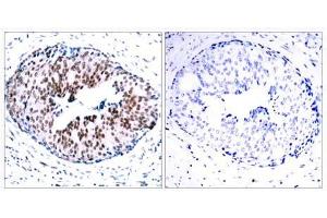 Immunohistochemical analysis of paraffin- embedded human breast carcinoma tissue using STAT5A (phospho-Ser780) antibody (E011049). (STAT5A antibody  (pSer780))