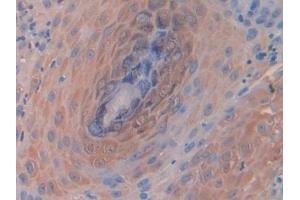 Detection of CD63 in Human Skin cancer Tissue using Polyclonal Antibody to Tetraspanin 30Cluster of Differentiation 63 (CD63) (CD63 antibody  (AA 103-203))