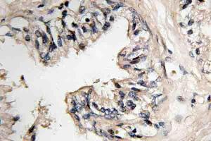 Immunohistochemistry (IHC) analyzes of MRP-S36 antibody in paraffin-embedded human prostate carcinoma tissue. (MRPS36 antibody)