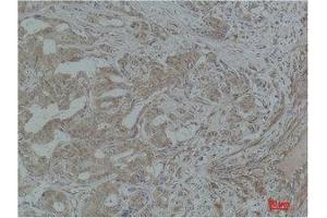 Immunohistochemistry (IHC) analysis of paraffin-embedded Human Breast Carcinoma using Stat3 Polyclonal Antibody. (STAT3 antibody)