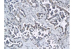 Formalin-fixed and paraffin embedded rat differentiated adenocarcinoma labeled with Anti ESAM Polyclonal Antibody, Unconjugated (ABIN758621) at 1:200 followed by conjugation to the secondary antibody and DAB staining