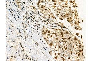 Phospho-p53 (Ser33) Antibody at 1/100 staining Human ovarian cancer by IHC-P. (p53 antibody  (pSer33))