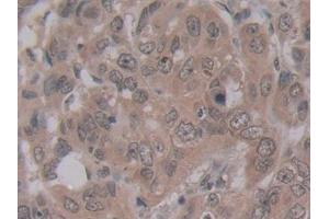 Detection of ENPP2 in Human Breast cancer Tissue using Monoclonal Antibody to Ectonucleotide Pyrophosphatase/Phosphodiesterase 2 (ENPP2) (ENPP2 antibody  (AA 637-905))