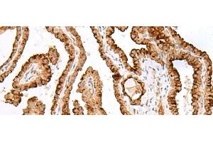 Immunohistochemistry of paraffin-embedded Human thyroid cancer tissue using SAXO2 Polyclonal Antibody at dilution of 1:40(x200) (FAM154B antibody)