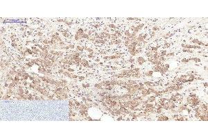 Immunohistochemistry of paraffin-embedded Human breast cancer tissue using LTF Monoclonal Antibody at dilution of 1:200. (Lactoferrin antibody)