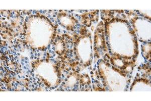 Immunohistochemistry of paraffin-embedded Human thyroid cancer tissue using SELENOS Polyclonal Antibody at dilution 1:40 (Selenoprotein S antibody)