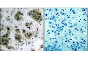Immunohistochemistry analysis of paraffin-embedded human breast carcinoma tissue, using Akt (Ab-473) Antibody. (AKT1 antibody  (AA 431-480))