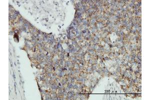 Immunoperoxidase of monoclonal antibody to MRPL12 on formalin-fixed paraffin-embedded human breast cancer tissue. (MRPL12 antibody  (AA 1-198))