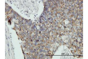 Immunoperoxidase of monoclonal antibody to MRPL12 on formalin-fixed paraffin-embedded human breast cancer tissue.