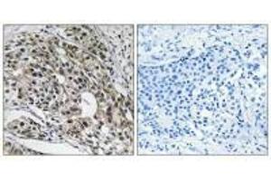 Immunohistochemistry analysis of paraffin-embedded human breast carcinoma tissue using MRPL13 antibody. (MRPL13 antibody  (C-Term))