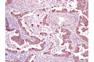 Formalin-fixed and paraffin embedded human lung carcinoma labeled with Anti-CD200R Polyclonal Antibody, Unconjugated (ABIN1713461) at 1:200 followed by conjugation to the secondary antibody and DAB staining (CD200R1 antibody  (AA 201-300))